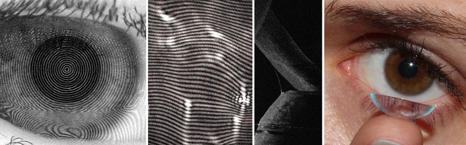 Tear film stability on contact lenses as an early prediction of contact lens-induced dry eye